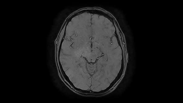 CT SCAN. Multispectral computed tomography of the head