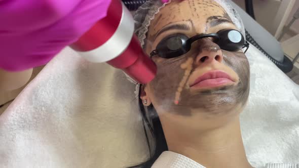 Carbon Face Peeling Procedure