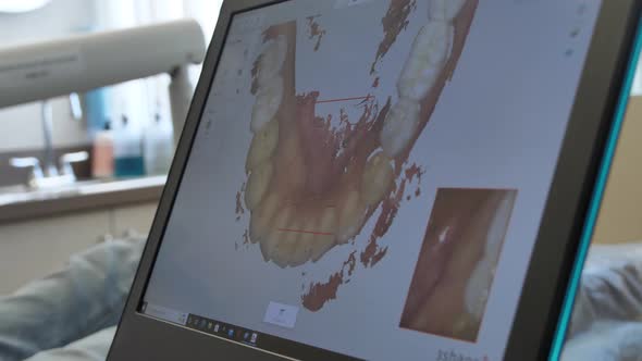 3D Scan of Teeth