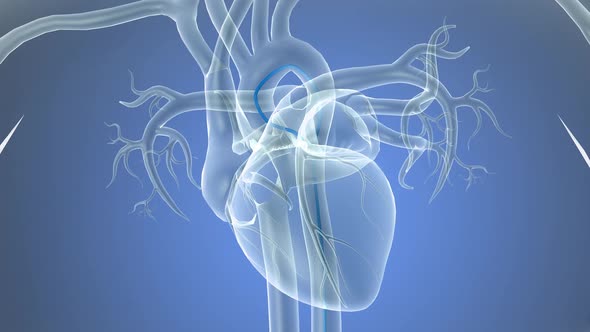 Opening the occluded artery by inserting a stent