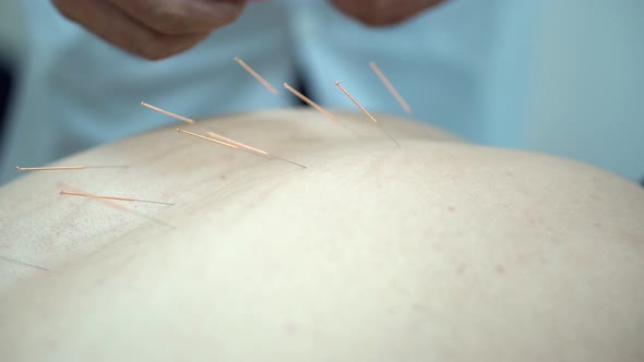 Close Up On Man Getting Acupuncture