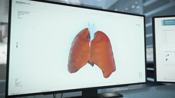 Affected Areas of 3d Lung In Medical Diagnostics Software On Computer Screen alt