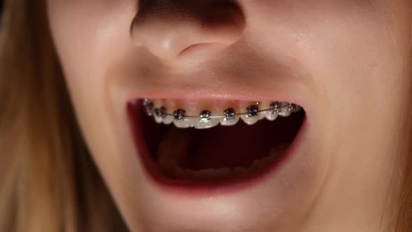 Girl Opens Her Mouth, Teeth with Braces