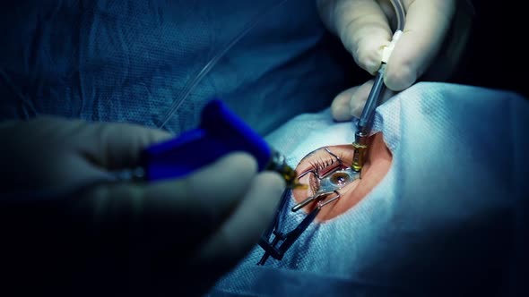 Surgeon hands in gloves performing laser eye vision correction