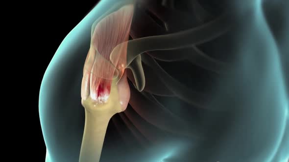 This video shows the rotator cuff surgery