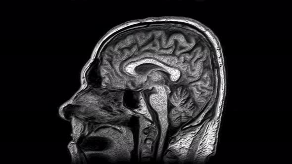 Voluminous MRI Scans of the Brain and Head To Detect Tumors. Diagnostic Medical Tool