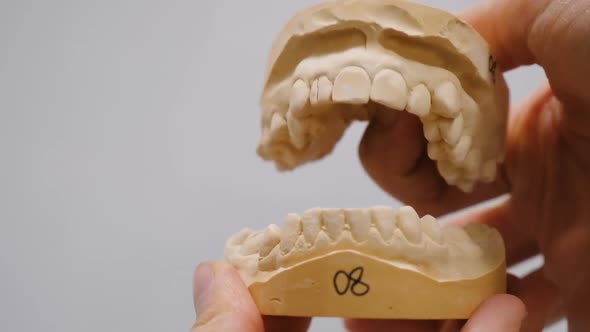 Gypsum Model of the Teeth Before Installing the Bracket System. Doctor Closes and Opens the Plaster