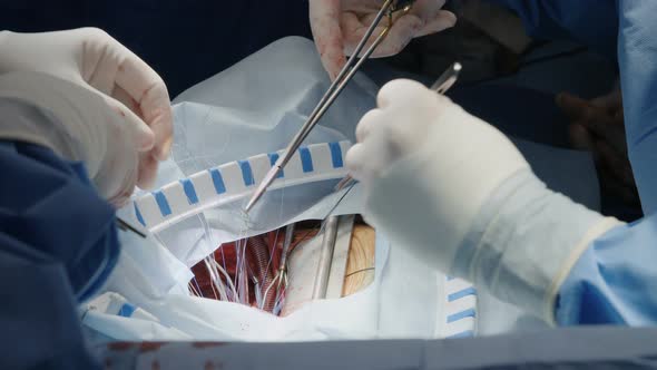 Surgeons working during open heart surgery, close up on hands and instruments.