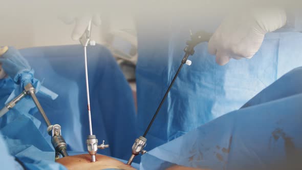 Operation Using Laparoscopic Equipment