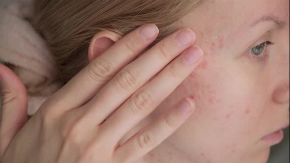 Woman with Post Acne Scars