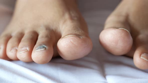 Close Up of Women's Infected Feet Fingers on Bed 