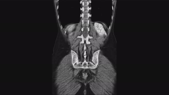 Voluminous MRI of the Female Pelvic Organs Abdominal Cavity Gastrointestinal Tract and Bladder