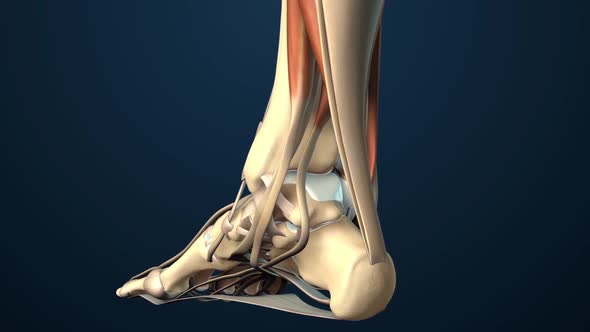 Torn Ligament or Tendon in the Foot