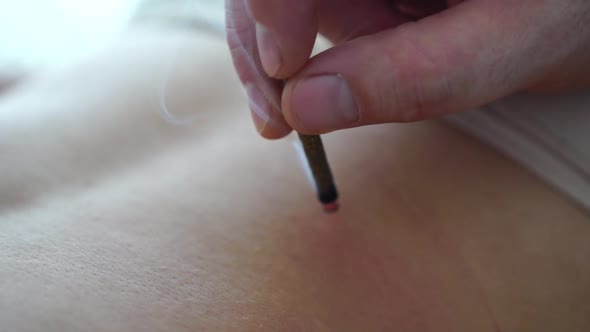 Therapist Performing Moxibustion Procedure at Health Center