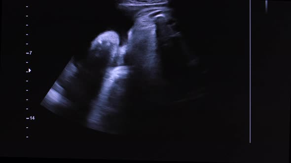 Image of Unborn Baby in Womb on Ultrasound Screen