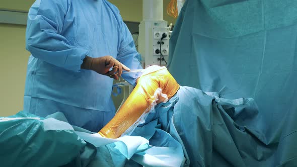 A Surgeon is Working on Patient's Leg