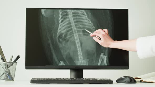 Doctor Veterinarian Examining Hedgehog Skeleton Roentgen on Computer Monitor