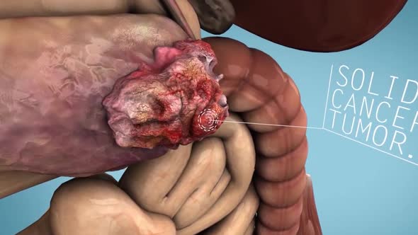 pancreatic cancer  medical animation