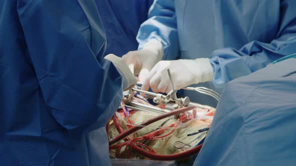 Surgeons working during open heart surgery, close up on hands and instruments.