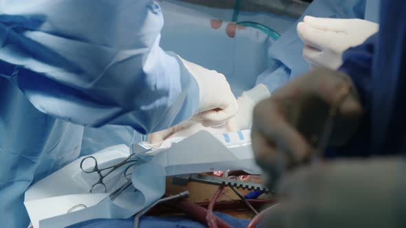 Surgeons working during open heart surgery, close up on hands and instruments.