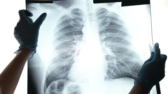 A woman in medical gloves shows fluorography. X-ray of the lungs