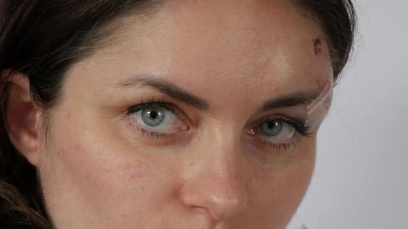 Large Real Bruise Hematoma Under the Eye of a Young Woman Fresh Purple Bruise and Scratches on the