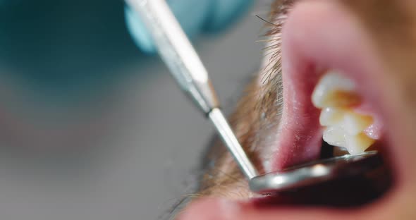 Dentist Examines the Patient's Oral Cavity Using a Dental Mirror