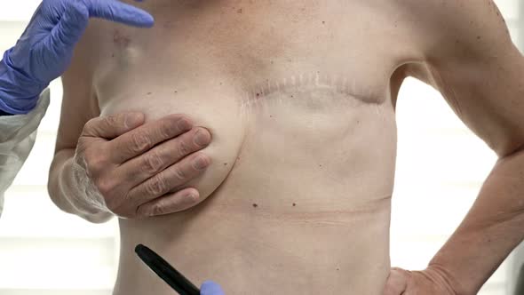 Preparing for Breast Reconstruction for a Woman Undergoing Mastectomy