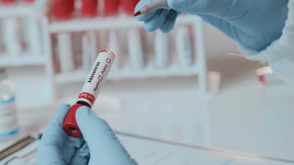 The Doctor Holds Hand Blood Sample Positive with Adenovirus
