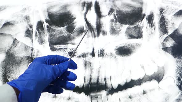 The Doctor Shows an X-ray on a Large Screen, Examining the Nasal Cavity. Modern Medicine