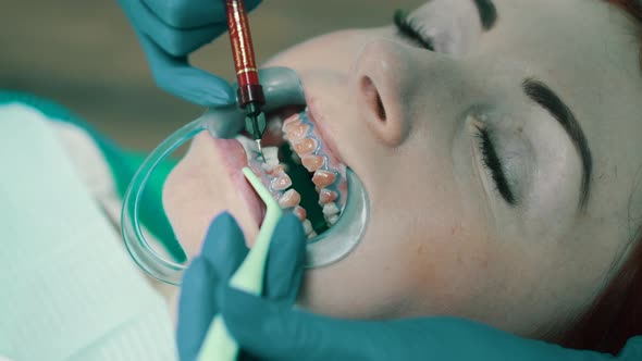 Application of Bleaching Gel for Procedure of Teeth Whitening