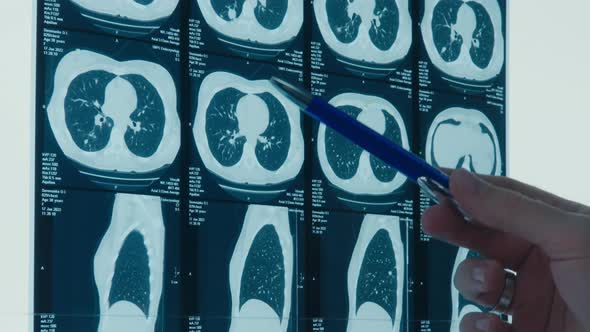 Doctor Shows Fluorography X Ray