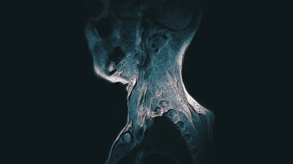 Voluminous Color MRI of the Cervical Spine, Detection of Protrusions and Hernias