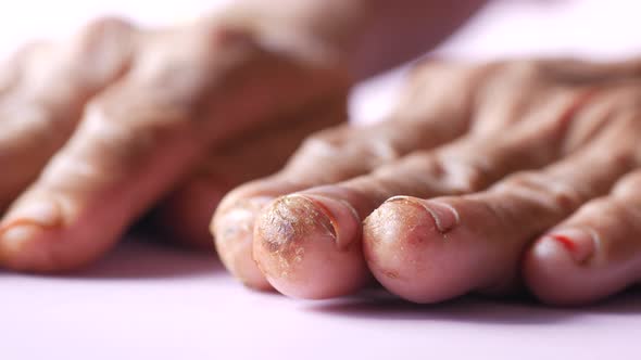 Senior Women's Hand with Infected and Dry Skin