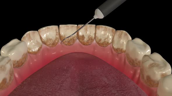 Dental Scaling Procedure